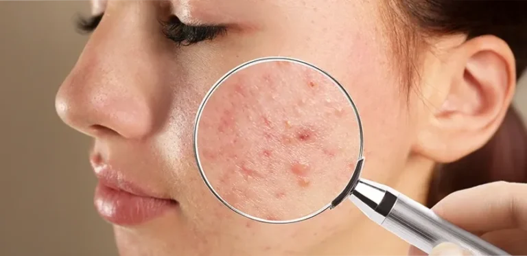 Common Skin Diseases